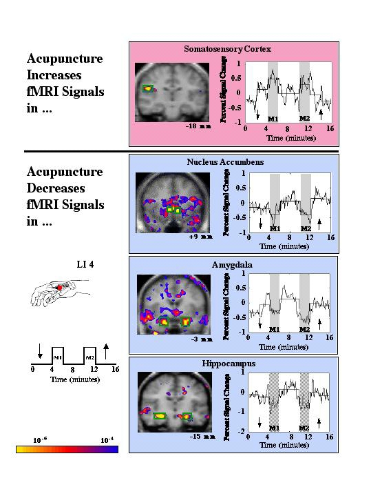 harvard fmri acu brain effect